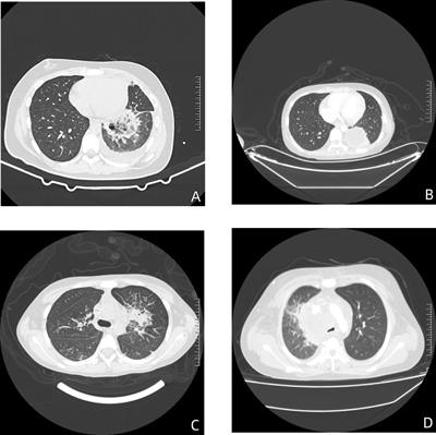 Clinical features of pediatric mucormycosis: role of metagenomic next generation sequencing in diagnosis